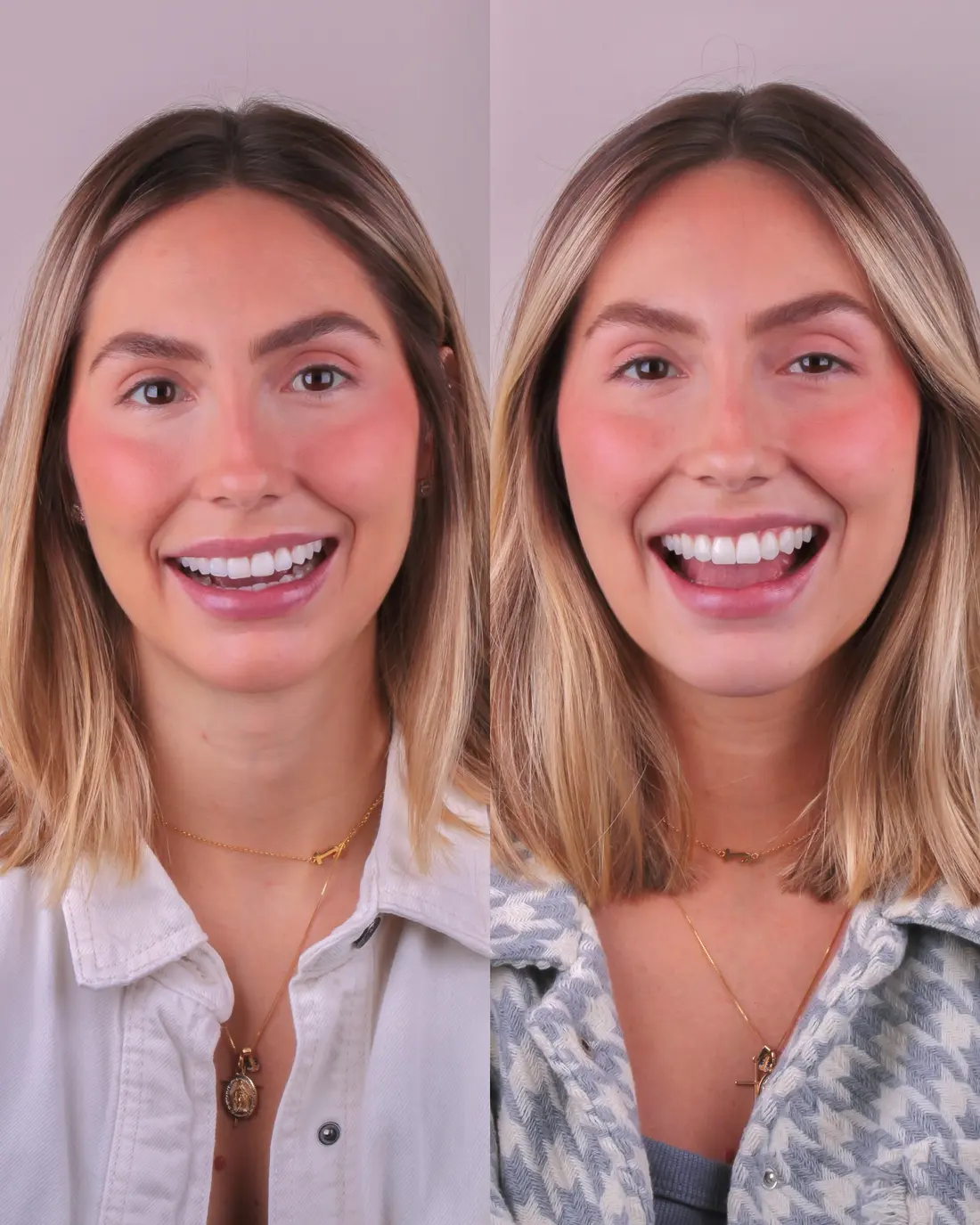 Comparativo real de sorriso antes e depois