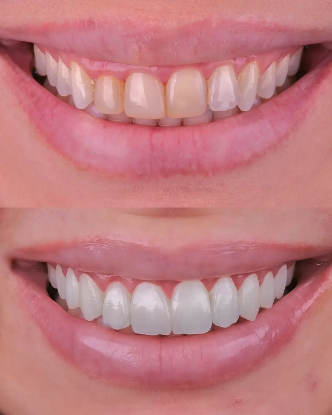 Comparativo real dos dentes antes e depois